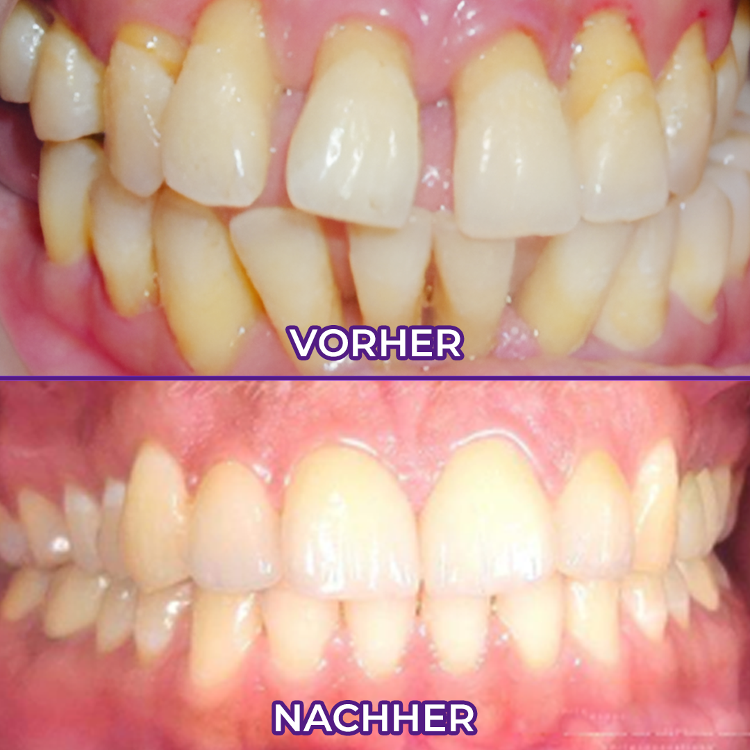 Ceoerty® VioletX Hochwirksamer Zahnaufhellungs-Komplex