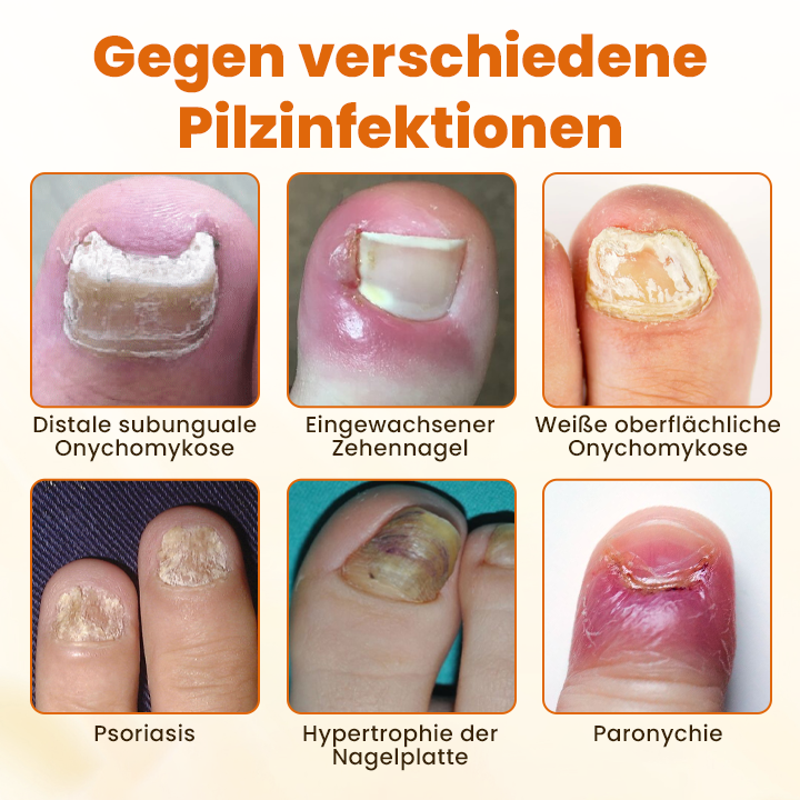 Timilk® FungiBee Fortschrittliches Nagelreparatur-Spray
