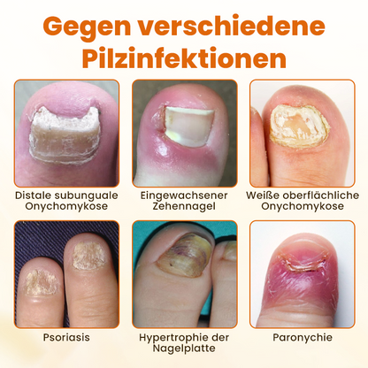 Timilk® FungiBee Fortschrittliches Nagelreparatur-Spray