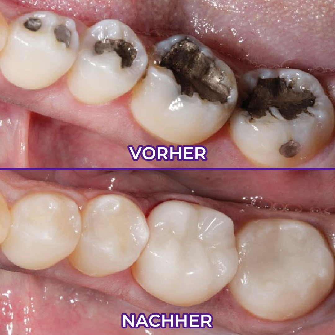 Ceoerty® VioletX Hochwirksamer Zahnaufhellungs-Komplex