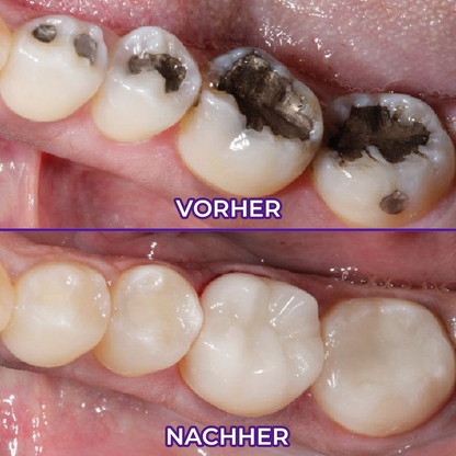 Ceoerty® VioletX Hochwirksamer Zahnaufhellungs-Komplex