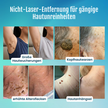 Timilk® SpotlessPro 7-Tage Fortschrittlicher Makel- & Hautanhängsel-Entferner