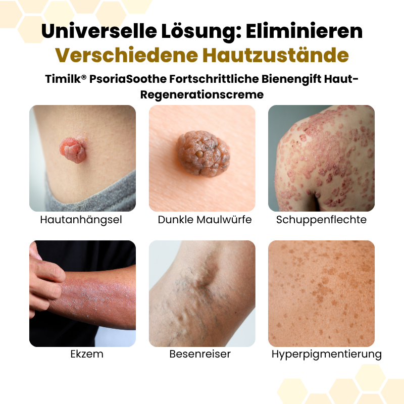 Timilk® PsoriaSoothe Fortschrittliche Bienengift Haut-Regenerationscreme🔥
