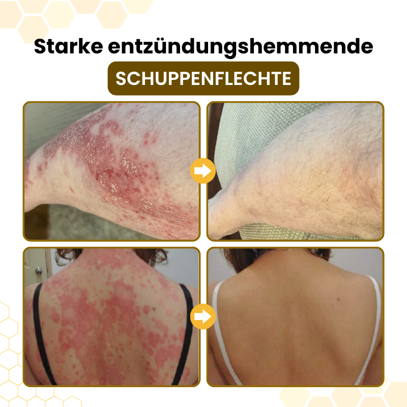 Timilk® PsoriaSoothe Fortschrittliche Bienengift Haut-Regenerationscreme🔥