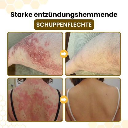 Timilk® PsoriaSoothe Fortschrittliche Bienengift Haut-Regenerationscreme🔥