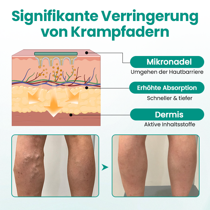 Timilk® LegRenew Krampfaderpflaster 🔥