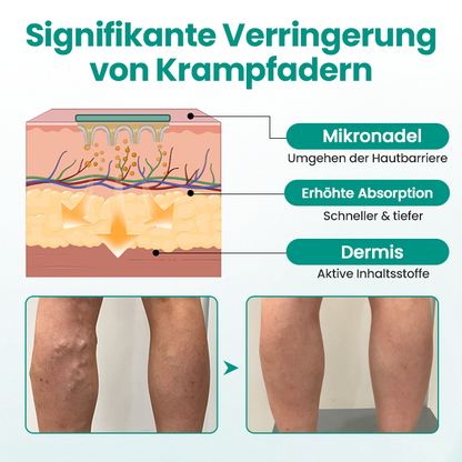 Timilk® LegRenew Krampfaderpflaster 🔥